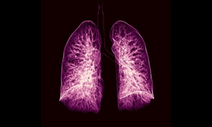 雲联人工智能可提前一年诊断出肺癌